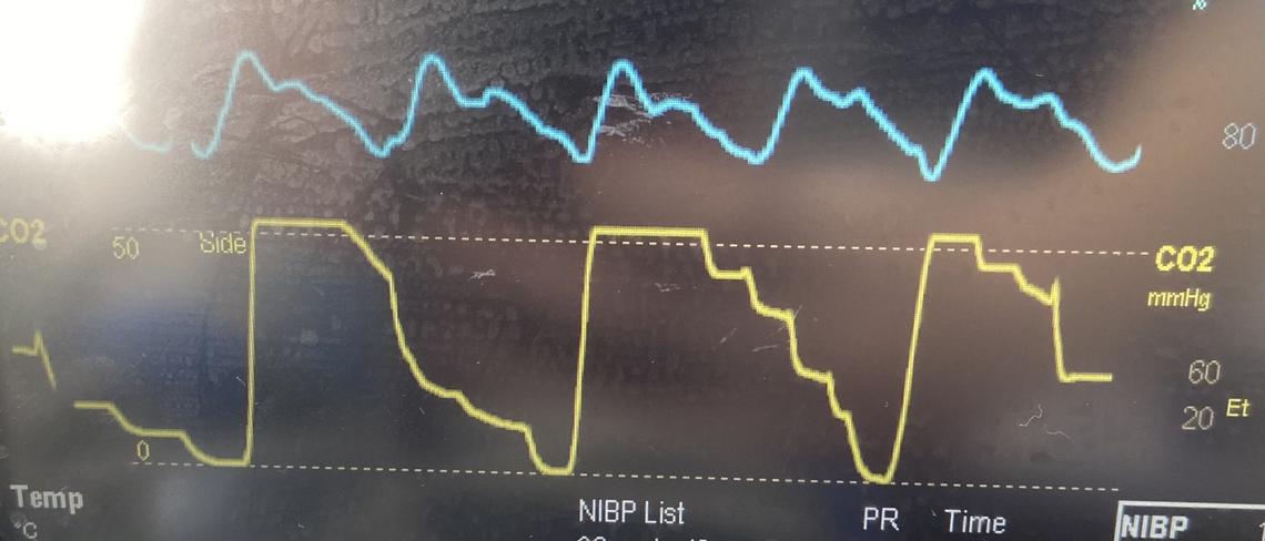 Capnography: the best anaesthetic monitoring tool? by Anarosa Wallace ...