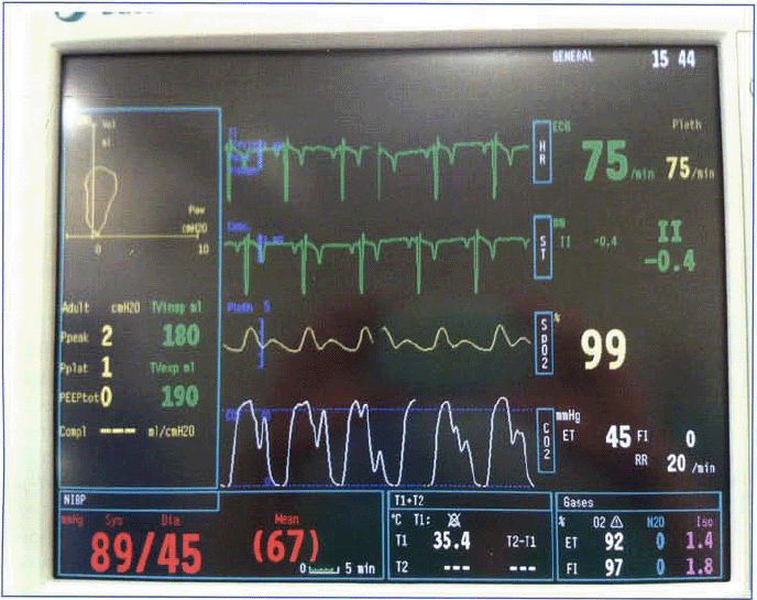 Anaesthetic emergencies by Mary Barker - British Veterinary Nursing ...